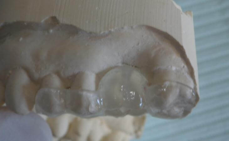 Surgical Guide For Decayed Tooth Replacement