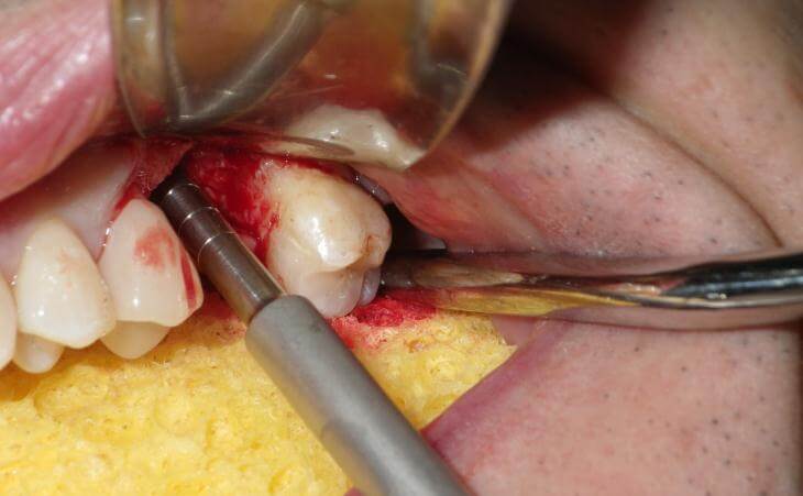 Internal Sinus Lift