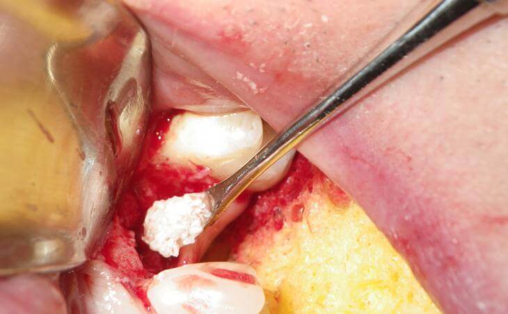 Bone Graft For Decayed Tooth Treatment