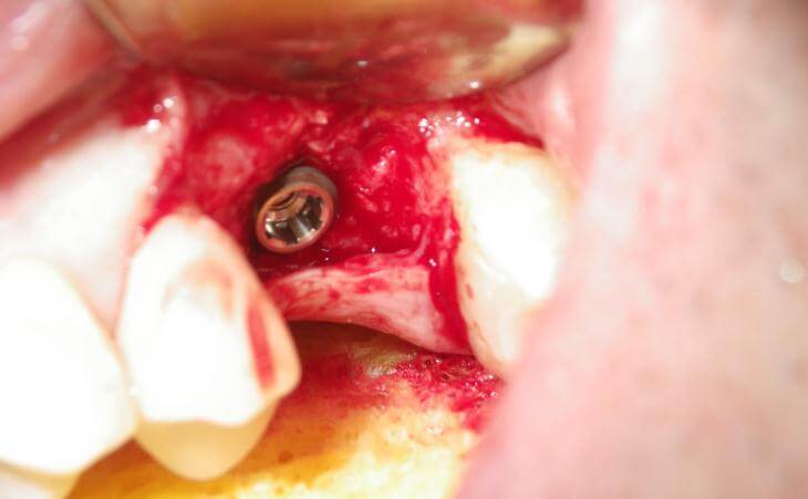 Proper Dental Implant Placement