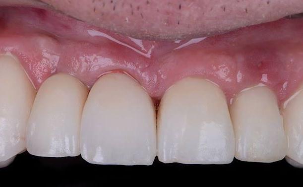 Dental Implant Results