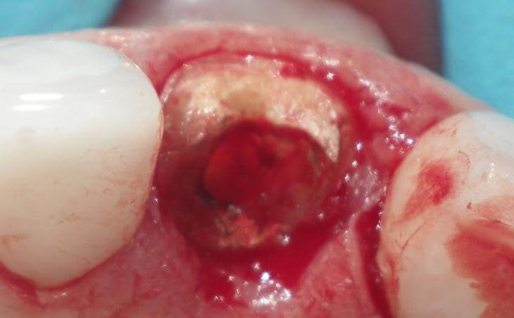Fractured Tooth Removal