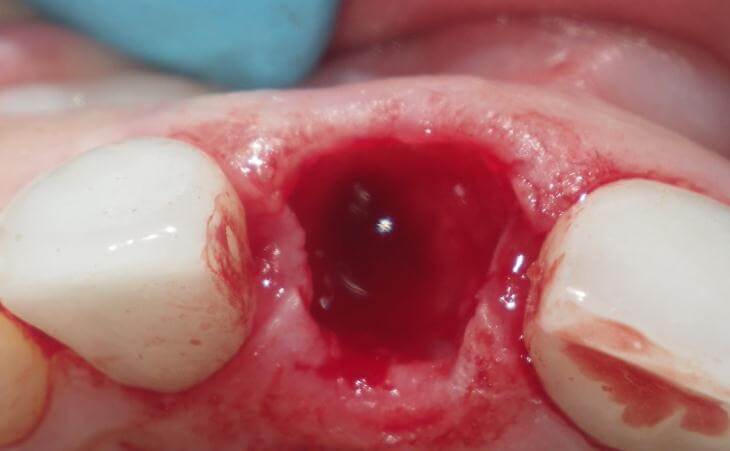 Removal Of Fractured Tooth