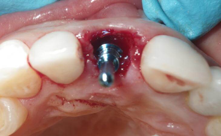 Placement Of Dental Implant