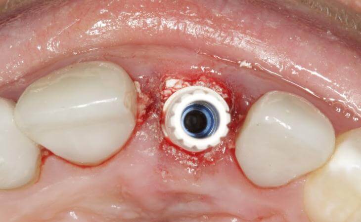 Temporary Abutment For Dental Implants