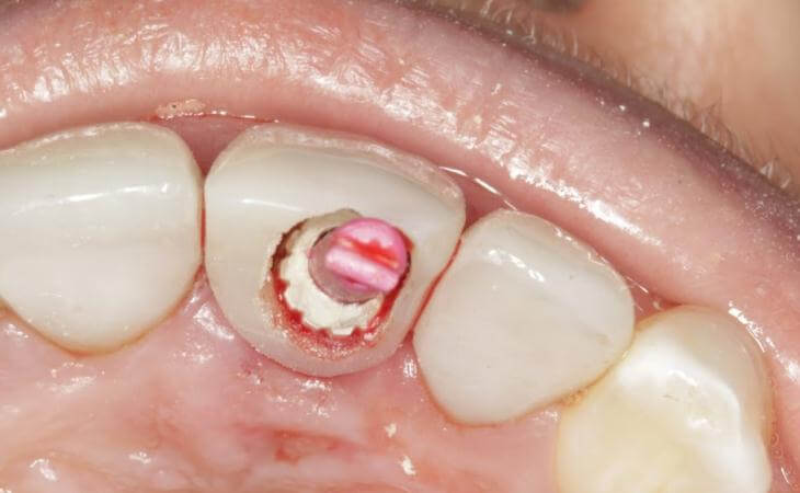Temporary Crown For Dental Implants