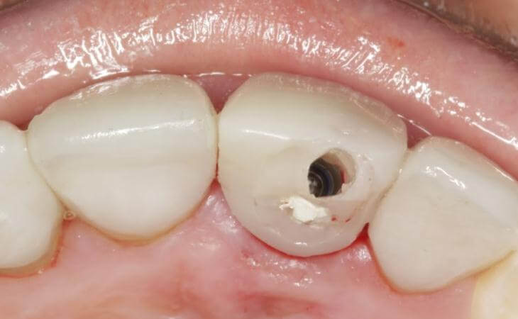 Tooth-Colored Filling For Dental Implants