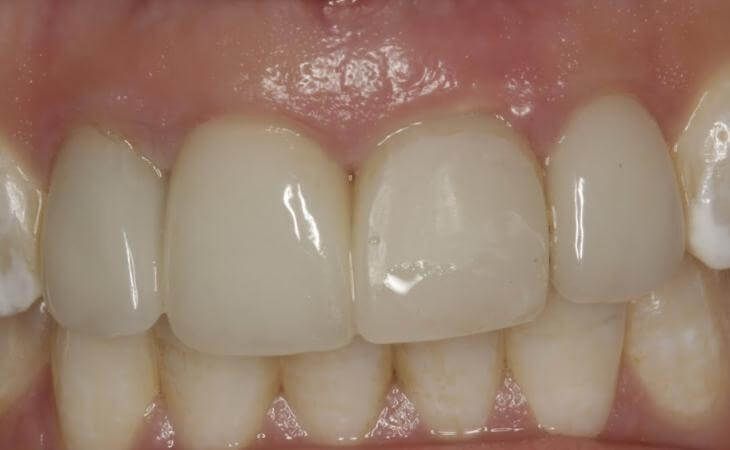 Temporary Dental Implant Restoration