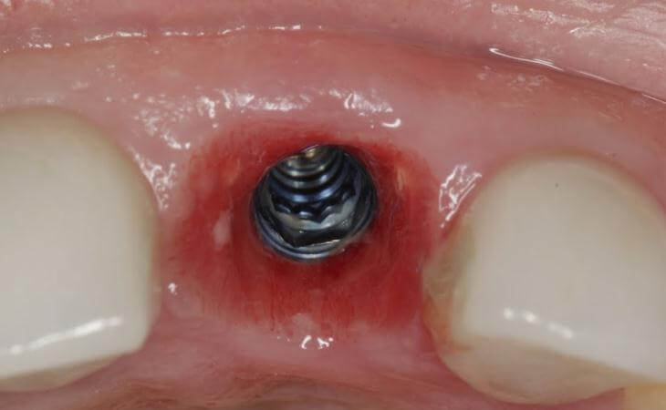 Healing Gum After Dental Implant Placement