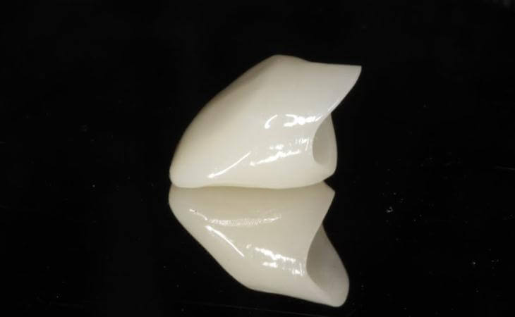 Final Dental Implant Crown