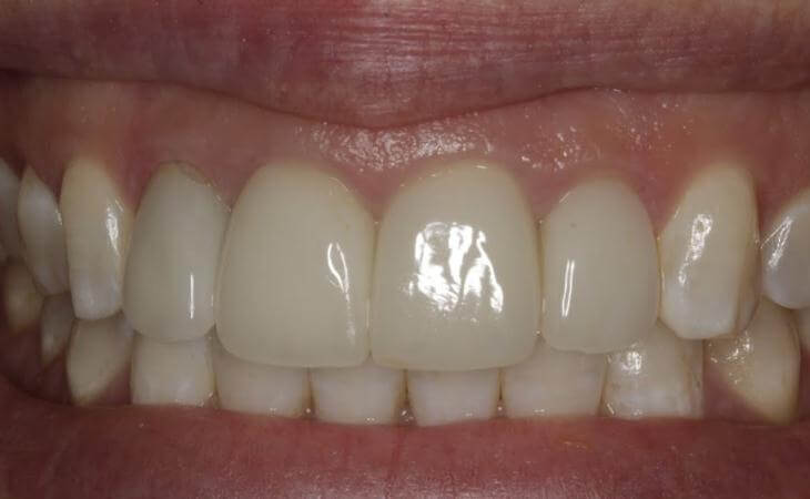 Missing Tooth Treatment Results