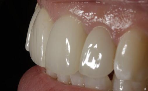 Final Dental Implant Results