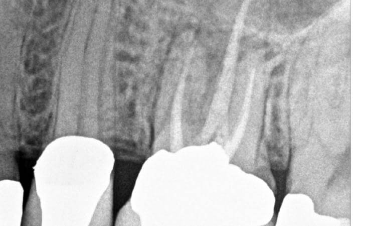 Decayed Tooth Treatment