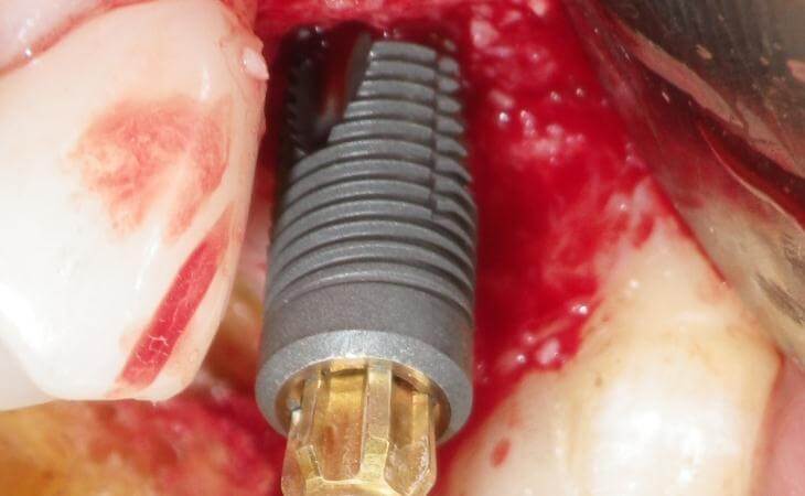 Placement of Dental Implant