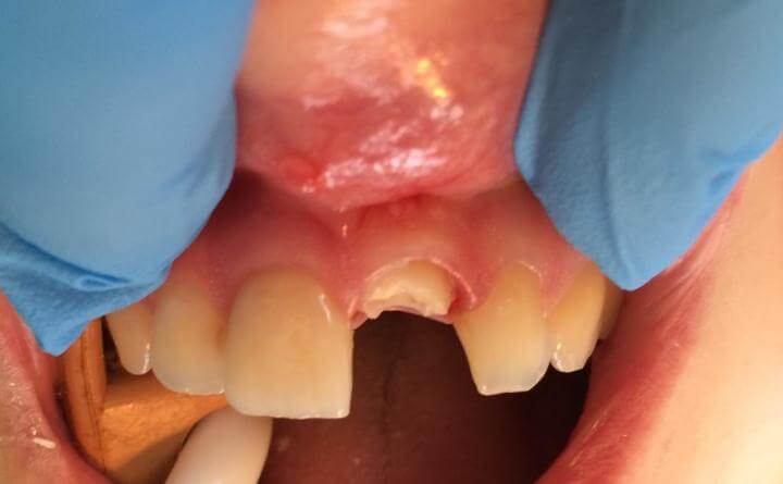 Broken Tooth Treatment