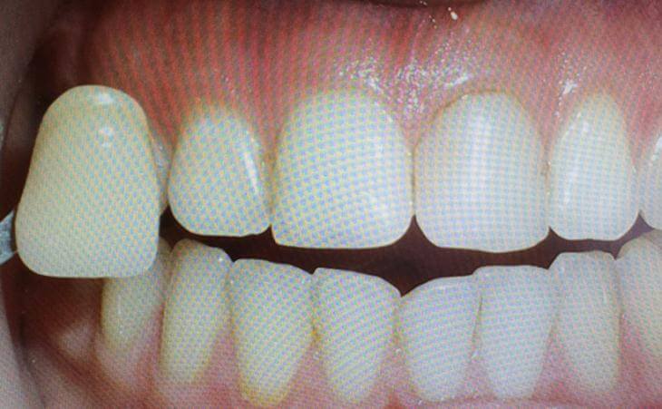 Broken Tooth Replacement