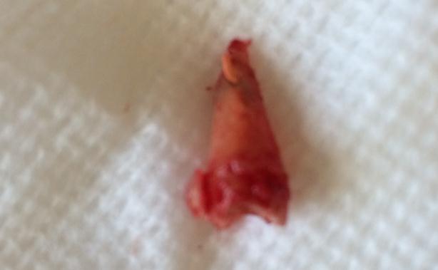 Broken Tooth Extraction