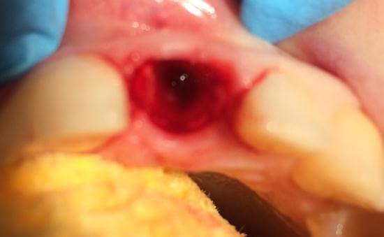 Bone Volume For Dental Implants