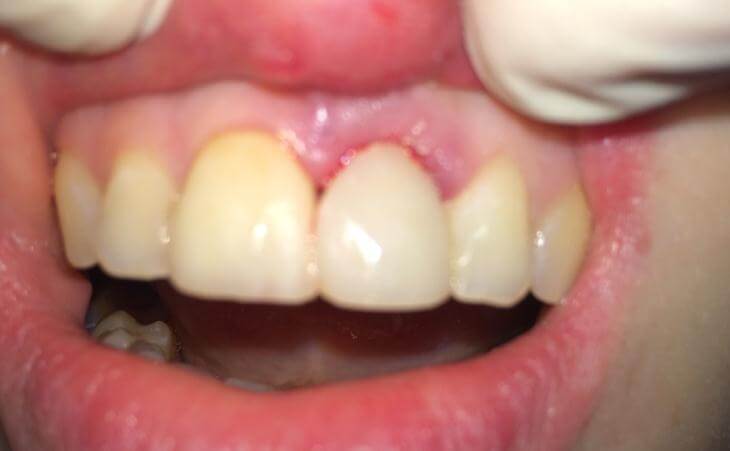 Same Day Dental Implant Results