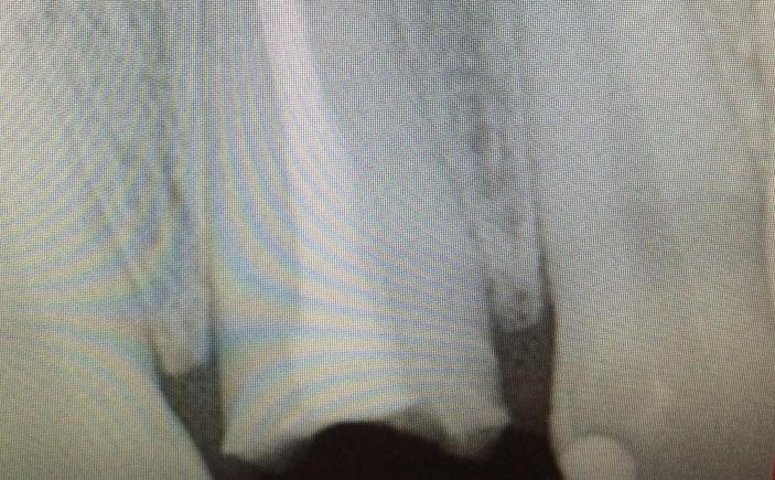 Dental X-Ray For Broken Tooth