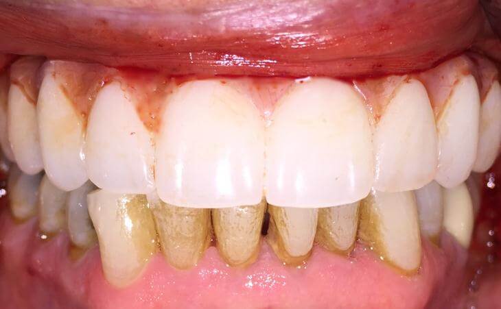 Immediate Full Upper Dental Implants