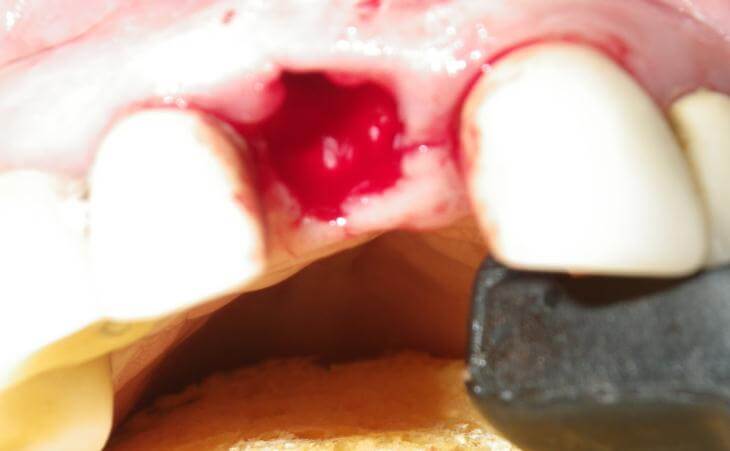 Removal Of Broken Front Tooth