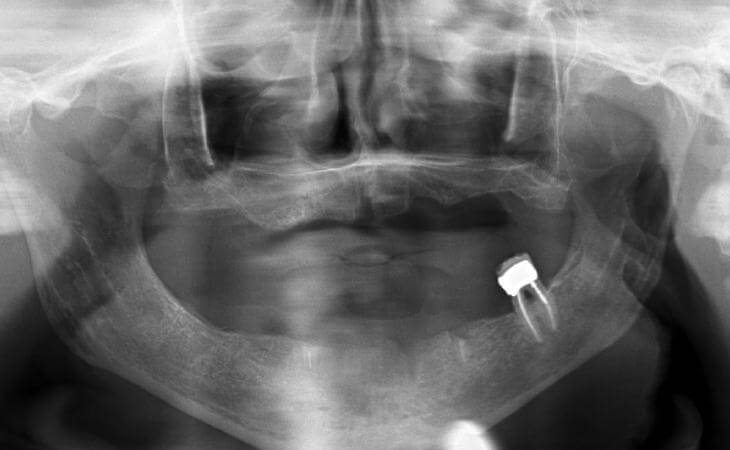 Implant-Supported Denture X-Ray