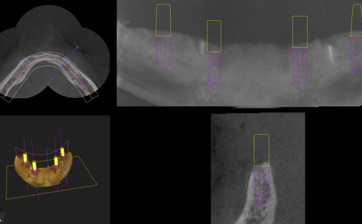 Virtual Planning For Implant-Supported Denture