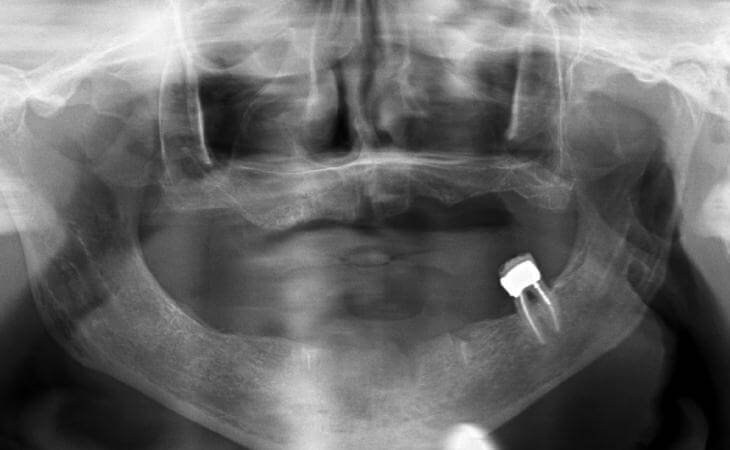 Dental Implant Surgery For Dentures