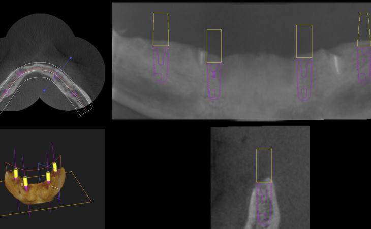 CT Scan For Dental Implants For Dentures