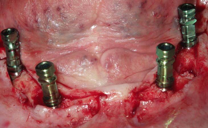 Dental Implant Placement For Dentures