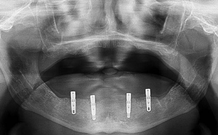 Dental Implants For Dentures X-Ray