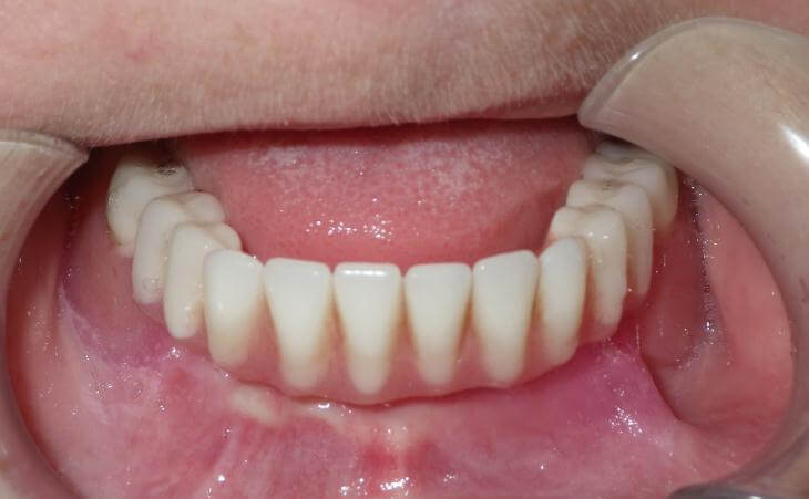 Loose Denture Solution