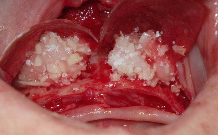 Jaw Bone After Bone Graft