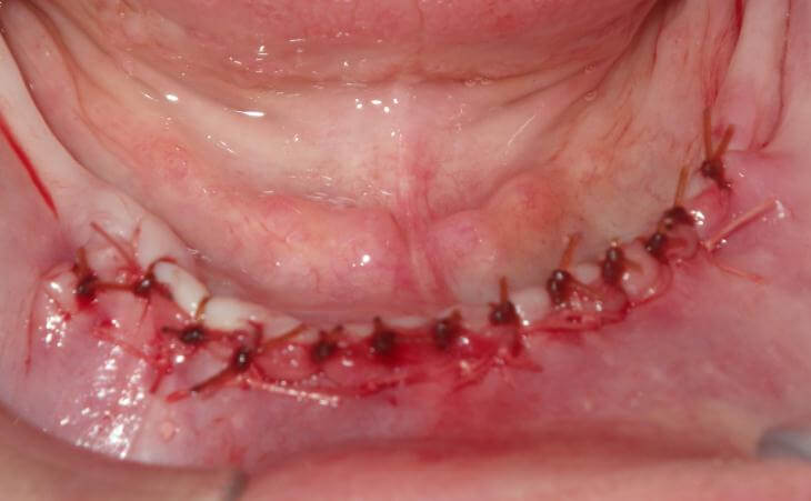 Bone Graft Surgery