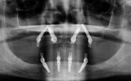 Dental Implants After Jaw Bone Graft