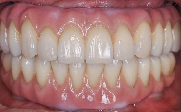Smile Restoration Results