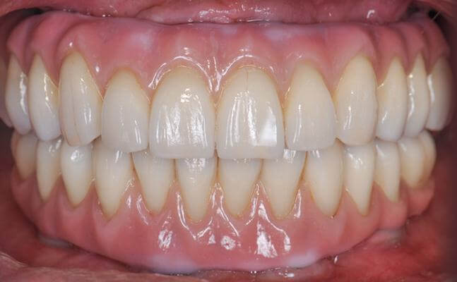 Bone Lost And Unstable Denture Treatment Results