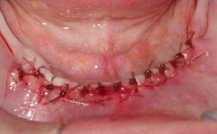 Bone Lost And Unstable Denture Surgery