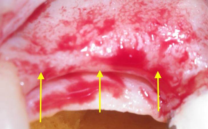 Thin Ridge Procedure