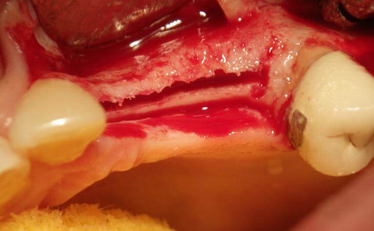 Split Ridge For Resorbed Ridge Treatment