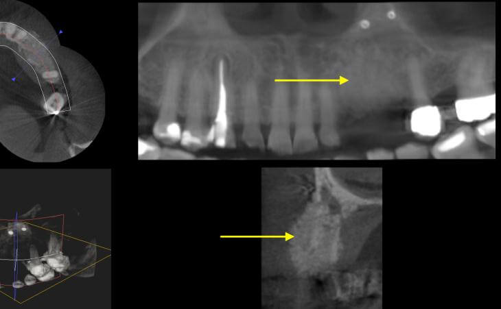 Ridge Bone Regeneration CT Scan