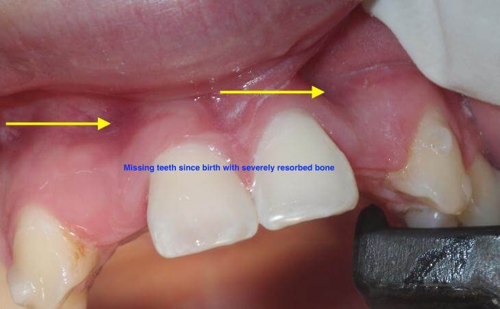Missing Lateral Teeth Replacement