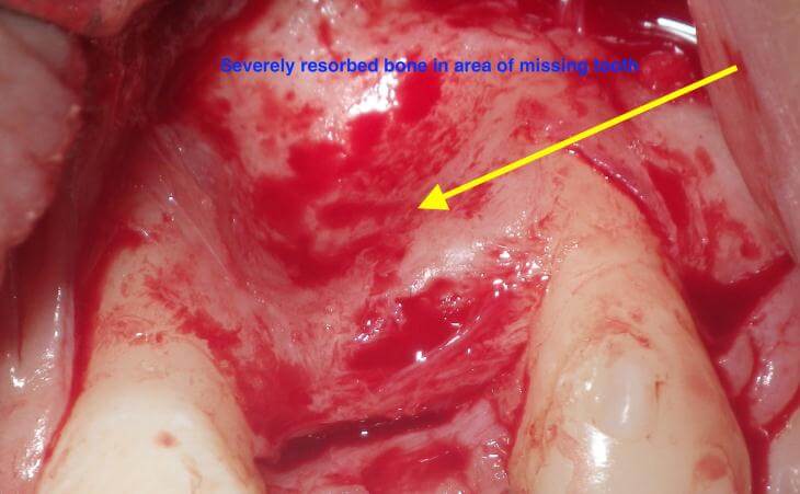 Bone Loss From Missing Teeth