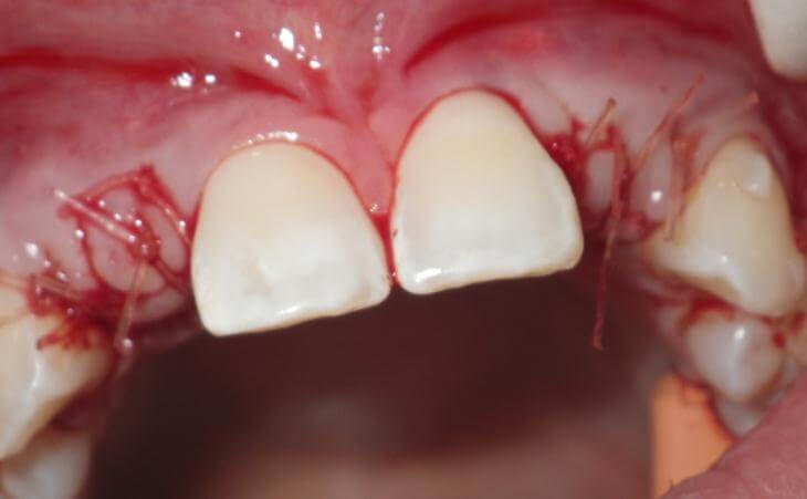 Bone Regeneration For Missing Teeth
