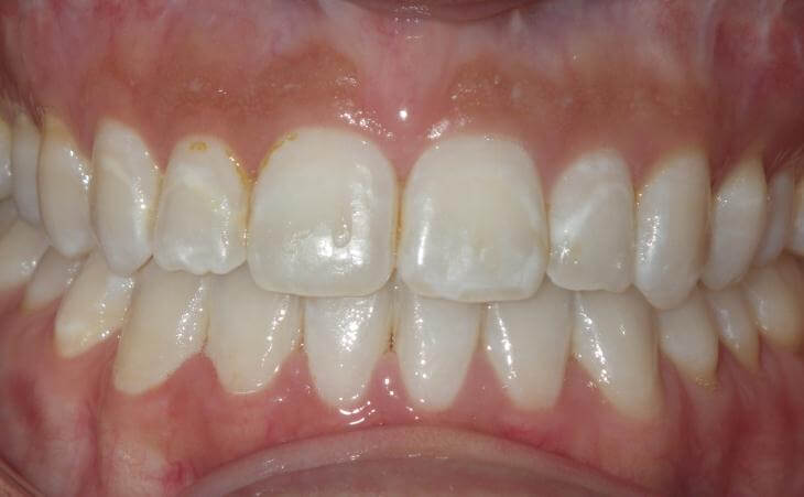 Results Of Small Upper Jaw Surgery
