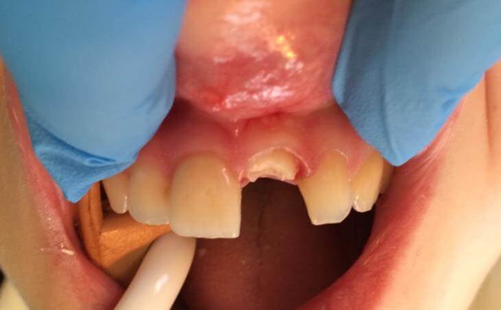 Broken Front Tooth Replacement 