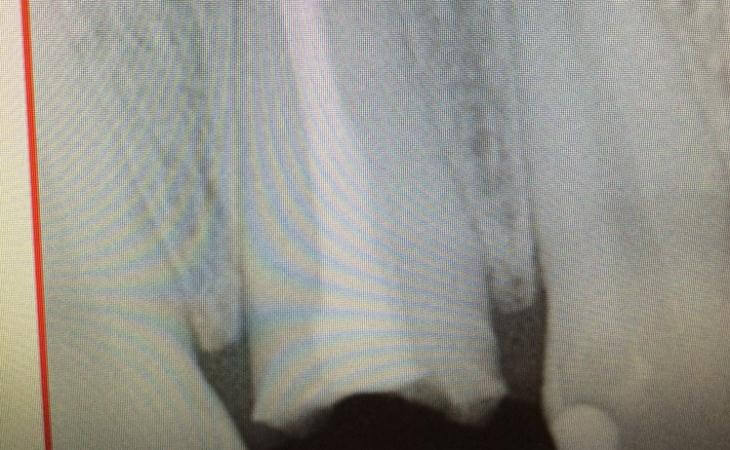 X-Ray Scan For Broken Tooth