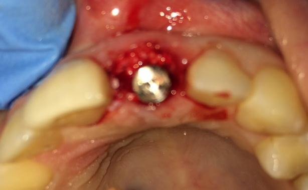 Bone Graft And Dental Implant Placement