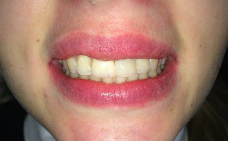 Same Day Dental Implant Results